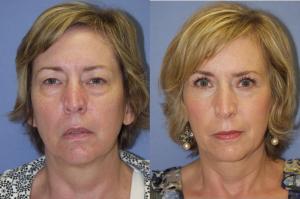 Blepharoplasty Before and After Image